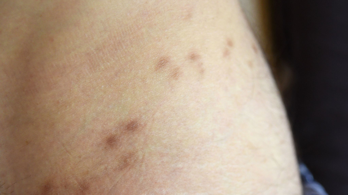 Krätze ist eine durch Milben verursachte ansteckende, nicht-tödliche Hautkrankheit. - Foto: Henning Kaiser/dpa