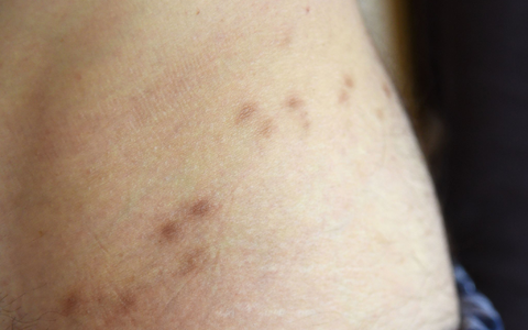 Krätze ist eine durch Milben verursachte ansteckende, nicht-tödliche Hautkrankheit. - Foto: Henning Kaiser/dpa