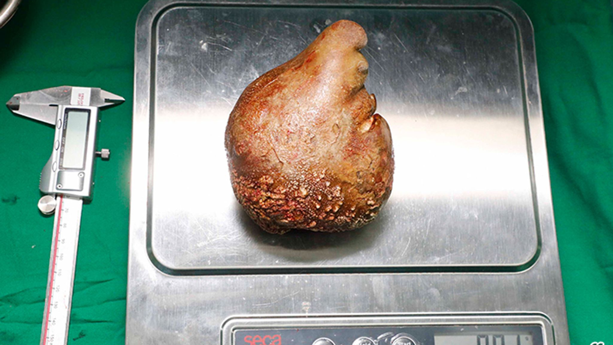 Das Foto zeigt den Nierenstein auf einer Waage. - Foto: Sri Lanka Army/dpa
