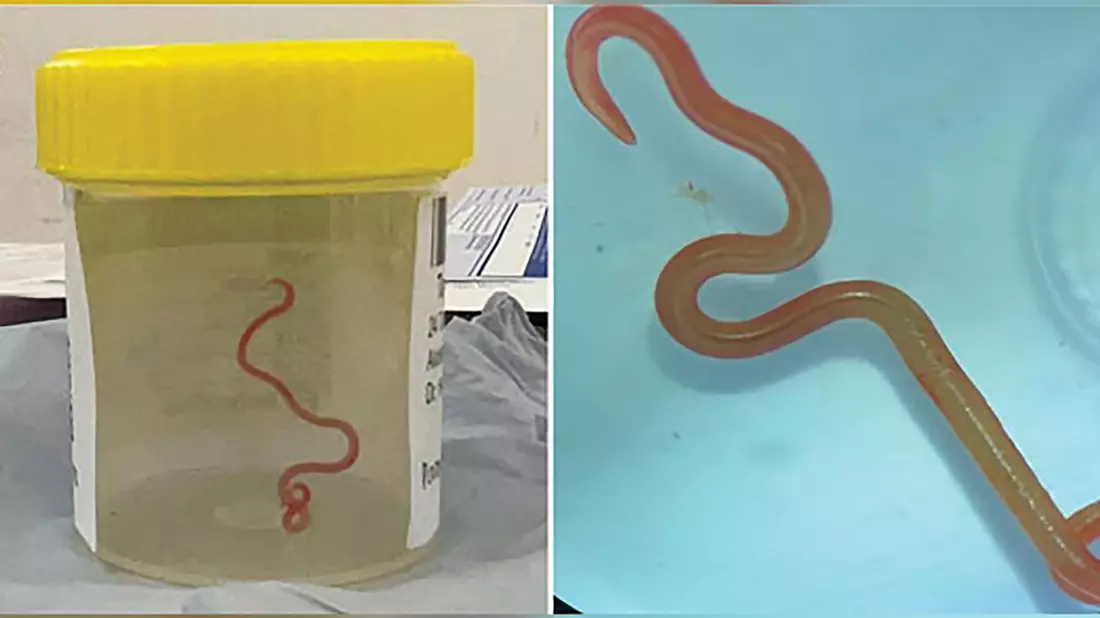 Der lebende Spulwurm «Ophidascaris robertsi» wurde im Gehirn einer 64-jährigen Australierin gefunden. - Bild: Emerging Infectious Diseases/AAP/dpa
