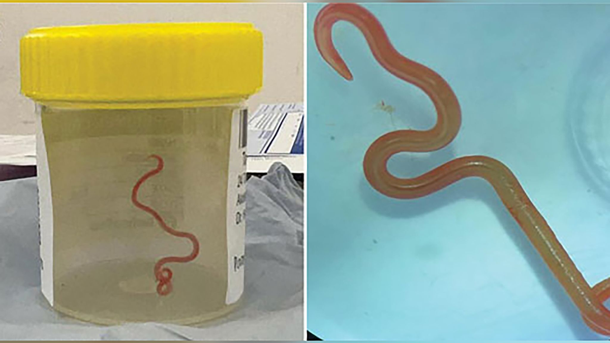 Der lebende Spulwurm «Ophidascaris robertsi» wurde im Gehirn einer 64-jährigen Australierin gefunden. - Foto: Emerging Infectious Diseases/AAP/dpa