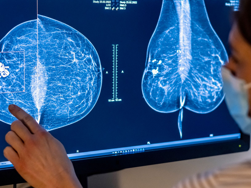 Medizinisches Personal untersucht mit einer Mammografie die Brust einer Frau auf Brustkrebs. - Foto: Hannibal Hanschke/dpa