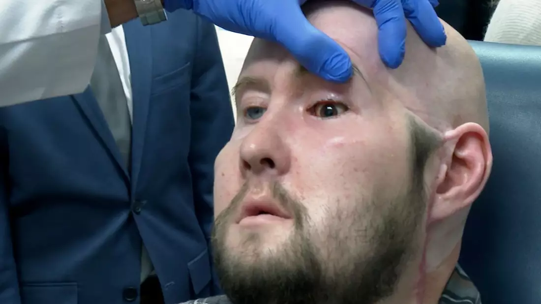 Einem US-amerikanischen Chirurgenteam ist eigenen Angaben zufolge die erste vollständige Augentransplantation weltweit gelungen. - Bild: Joseph. B. Frederick/AP/dpa