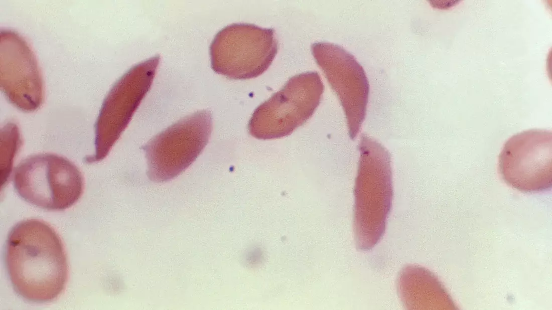 Mikroskopbild zeigt halbmondförmige rote Blutkörperchen eines an Sichelzellenanämie erkrankten Patienten aus dem Jahr 1972. - Bild: F. Gilbert/CDC/AP
