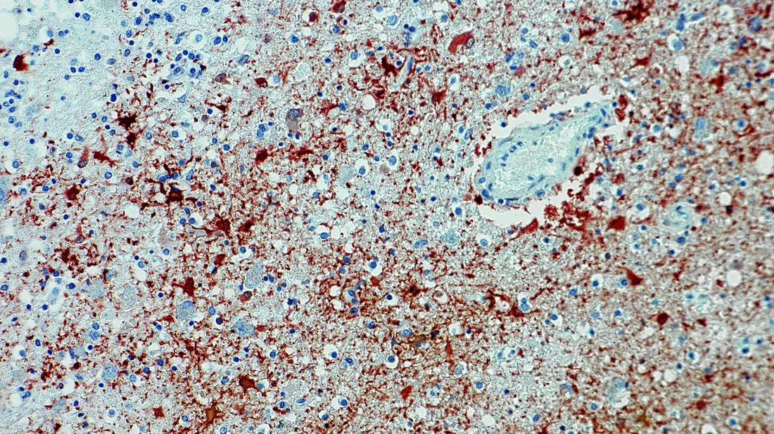 Die undatierte Aufnahme zeigt einen Anitkörpernachweis zum Borna-Virus im Gewebe. - Bild: Bernhard-Nocht-Institut für Tropenmedizin/dpa
