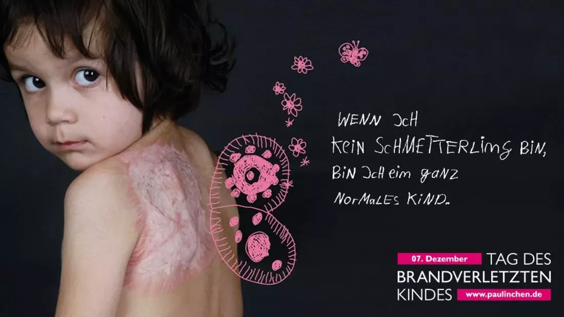 Tag des brandverletzten Kindes am 7. Dezember / Brandheiß! Brandgefährlich! Brandverletzt - Bild: presseportal.de