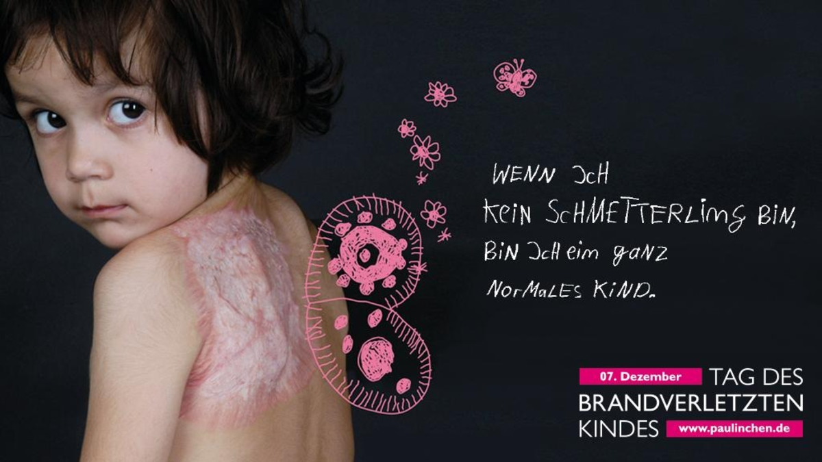 Tag des brandverletzten Kindes am 7. Dezember / Brandheiß! Brandgefährlich! Brandverletzt - Foto: presseportal.de