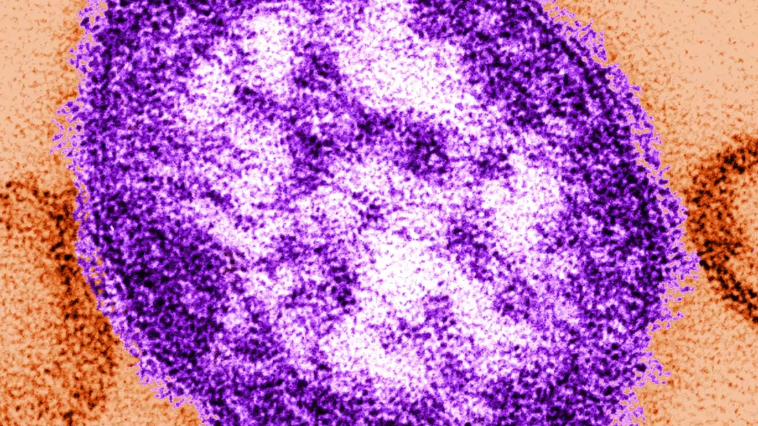 Masern verbreiten sich in Texas. - Bild: Cynthia Goldsmith/Centers for Disease Control and Prevention/dpa