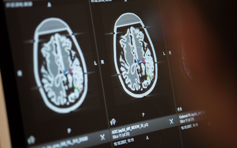 Die Fallzahlen für Erkrankungen des Nervensystems sind weltweit deutlich gestiegen. - Foto: Lino Mirgeler/dpa