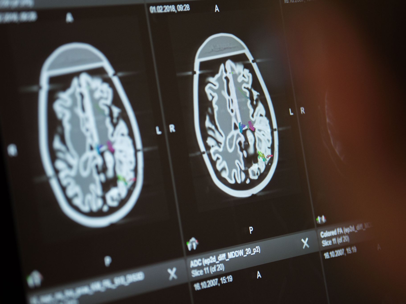 Die Fallzahlen für Erkrankungen des Nervensystems sind weltweit deutlich gestiegen. - Foto: Lino Mirgeler/dpa