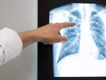 Röntgenbild einer Lunge. Im vergangenem Jahr würden rund 4480 neue Tuberkulose-Fälle in Deutschland registriert. - Foto: Silas Stein/dpa