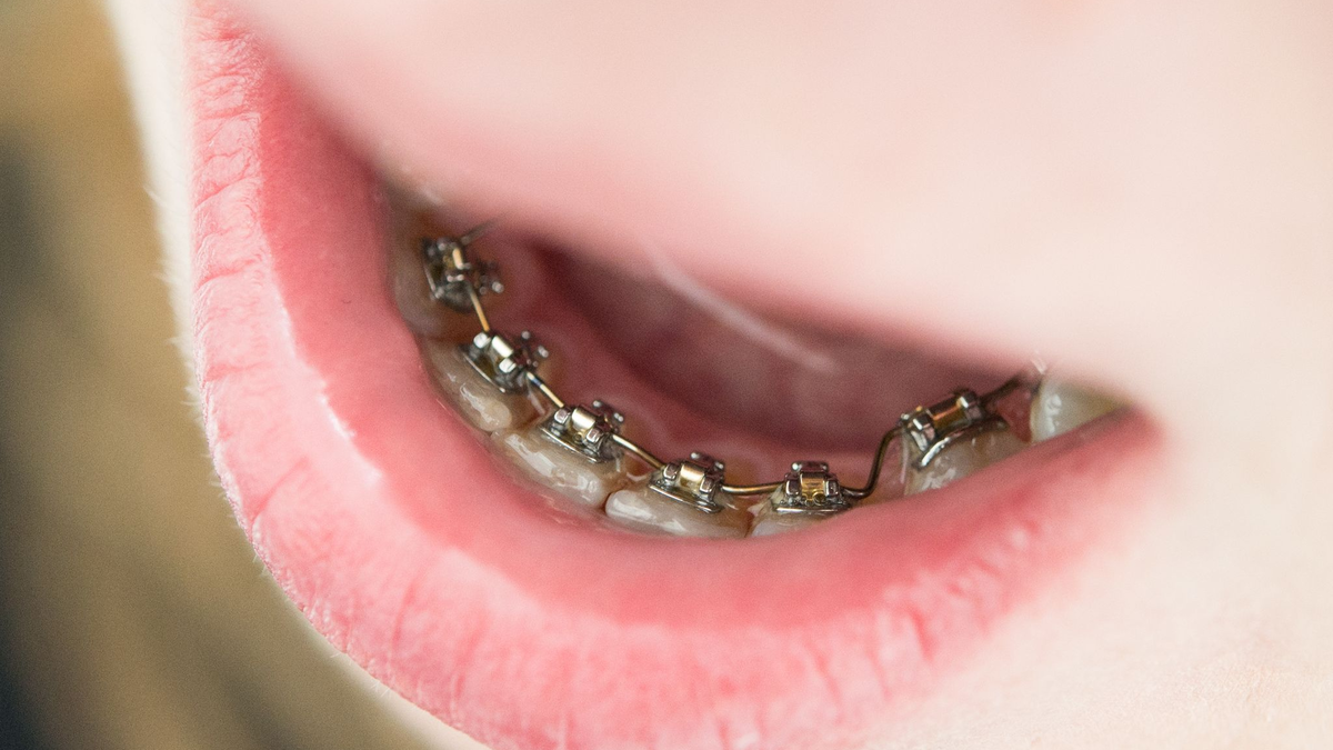 Gegen schiefe Zähne hilft eine Zahnspange. - Foto: Franziska Gabbert/dpa