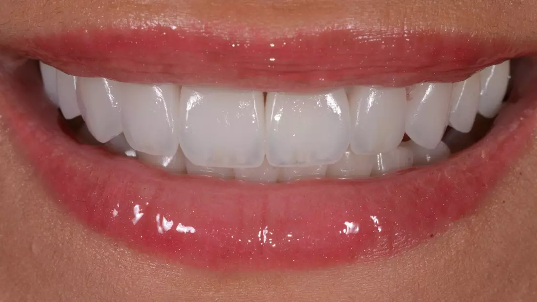 Aligner aus dem Onlineshop? Zahnarzt verrät, welche 5 Risiken diese Methode zur Zahnkorrektur birgt - Bild: presseportal.de