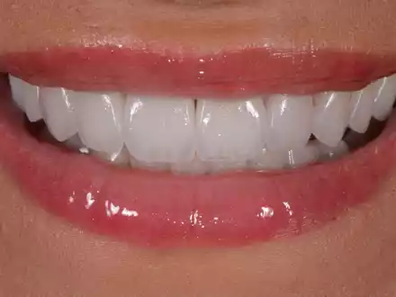 Aligner aus dem Onlineshop? Zahnarzt verrät, welche 5 Risiken diese Methode zur Zahnkorrektur birgt - Foto: presseportal.de