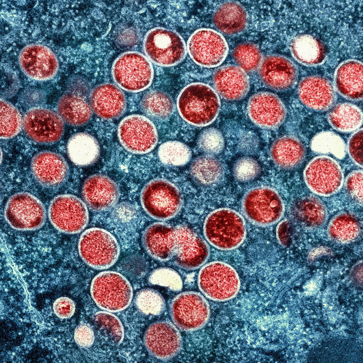 Überlässt die Welt die Zukunft von Mpox der Natur und dem Zufall? (Archivbild) - Foto: -/National Institute of Allergy and Infectious Diseases/dpa