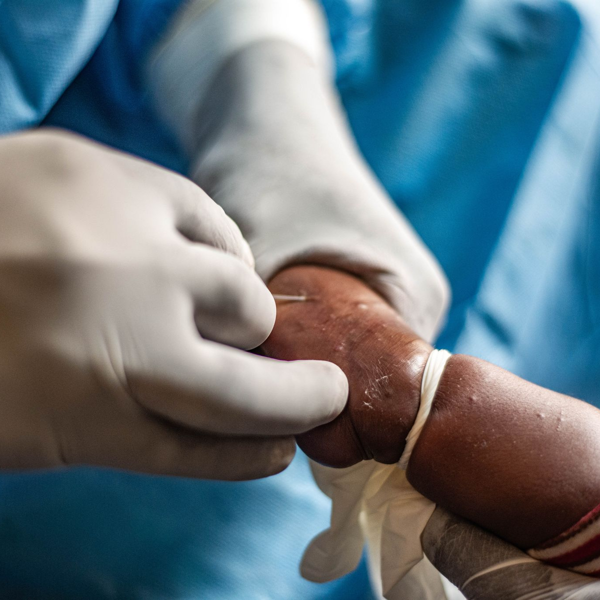 Mpox breitet sich in Afrika derzeit immer mehr aus. Hier wird ein Kind behandelt. (Archivbild) - Foto: Zanem Nety Zaidi/XinHua/dpa