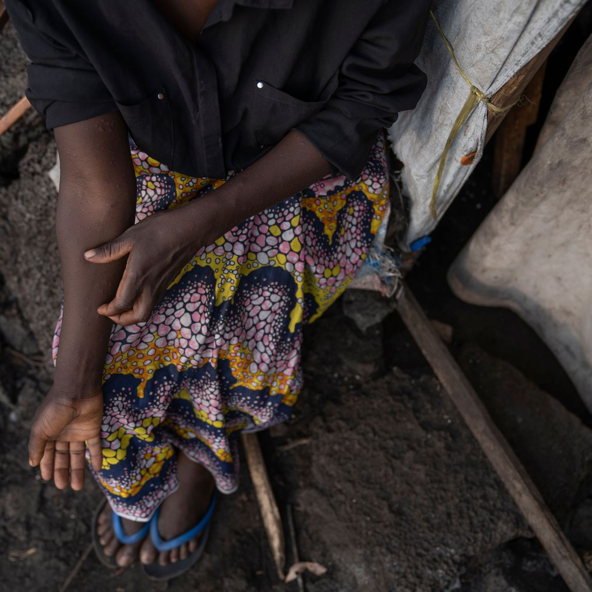 Ein erster Fall von Mpox ist in Deutschland nachgewiesen worden (Foto Archiv) - Foto: Moses Sawasawa/AP/dpa