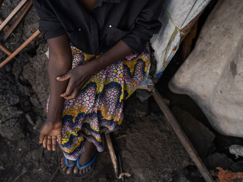 Ein Mpox-Behandlungszentrum im Kongo. - Foto: Moses Sawasawa/AP/dpa