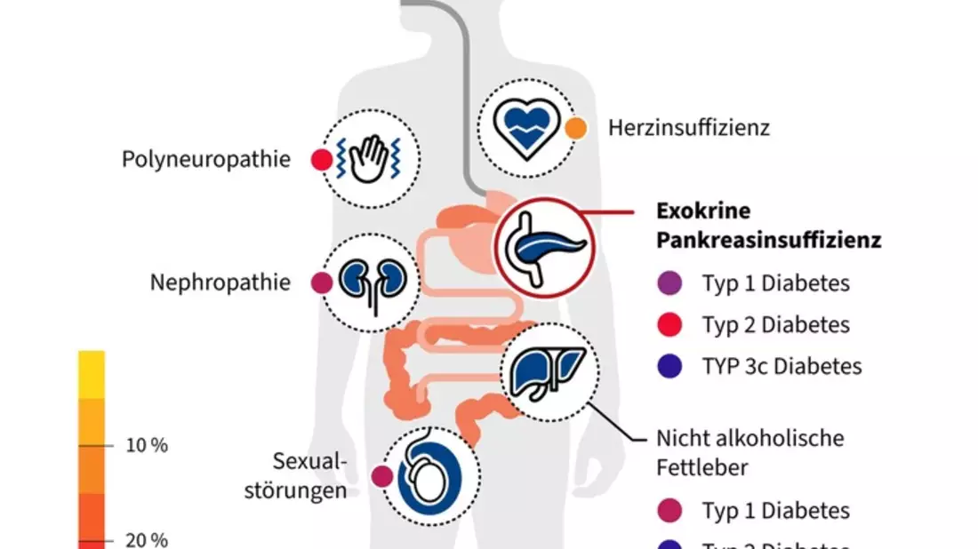 Unterschätzte Gefahr bei Diabetes mellitus: Unterzuckerungen durch Verdauungsenzymmangel - Bild: presseportal.de