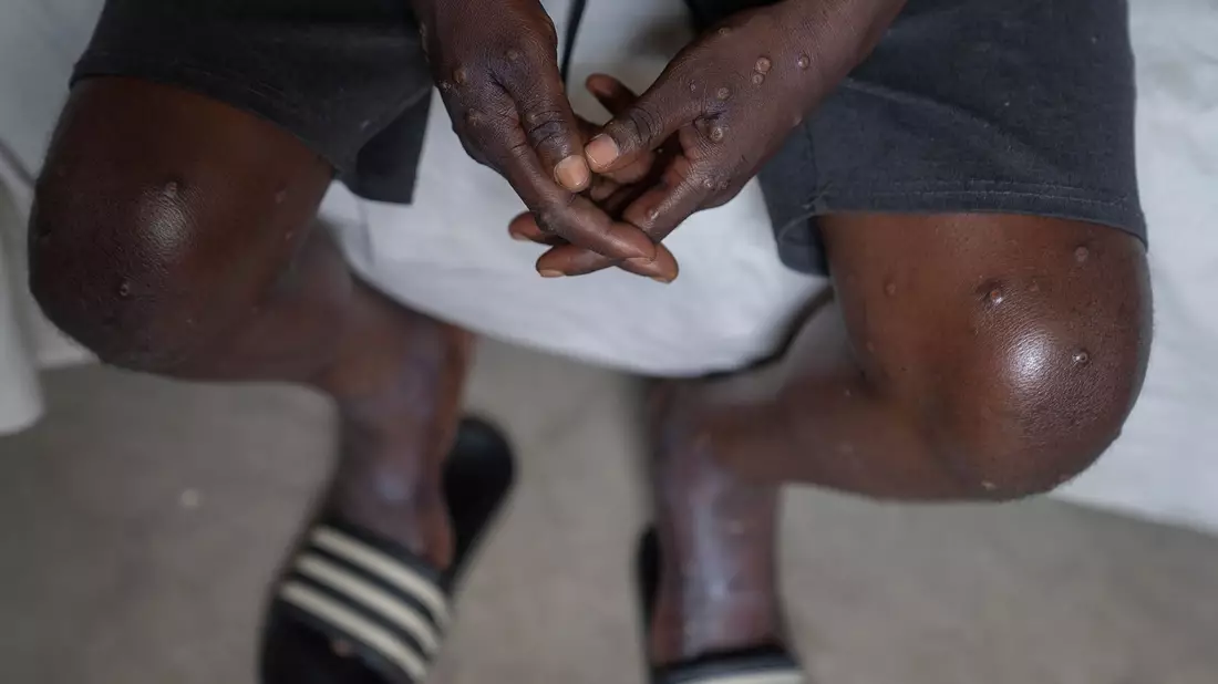 Impfstoff ist kein Allheilmittel, sagt die WHO. - Bild: Moses Sawasawa/AP/dpa