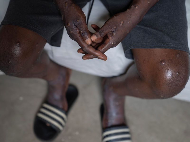 Impfstoff ist kein Allheilmittel, sagt die WHO. - Foto: Moses Sawasawa/AP/dpa