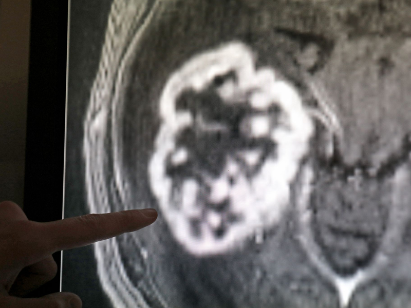 miRNAs spielen eine große Rolle bei Tumoren. (Archivbild) - Foto: Bernd Wüstneck/dpa