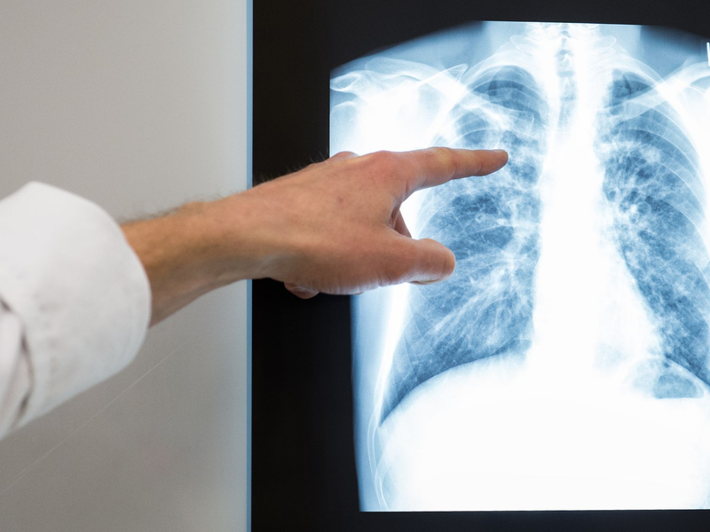 TB war 2023 unter Infektionskrankheiten die häufigste Todesursache.  - Foto: Silas Stein/dpa