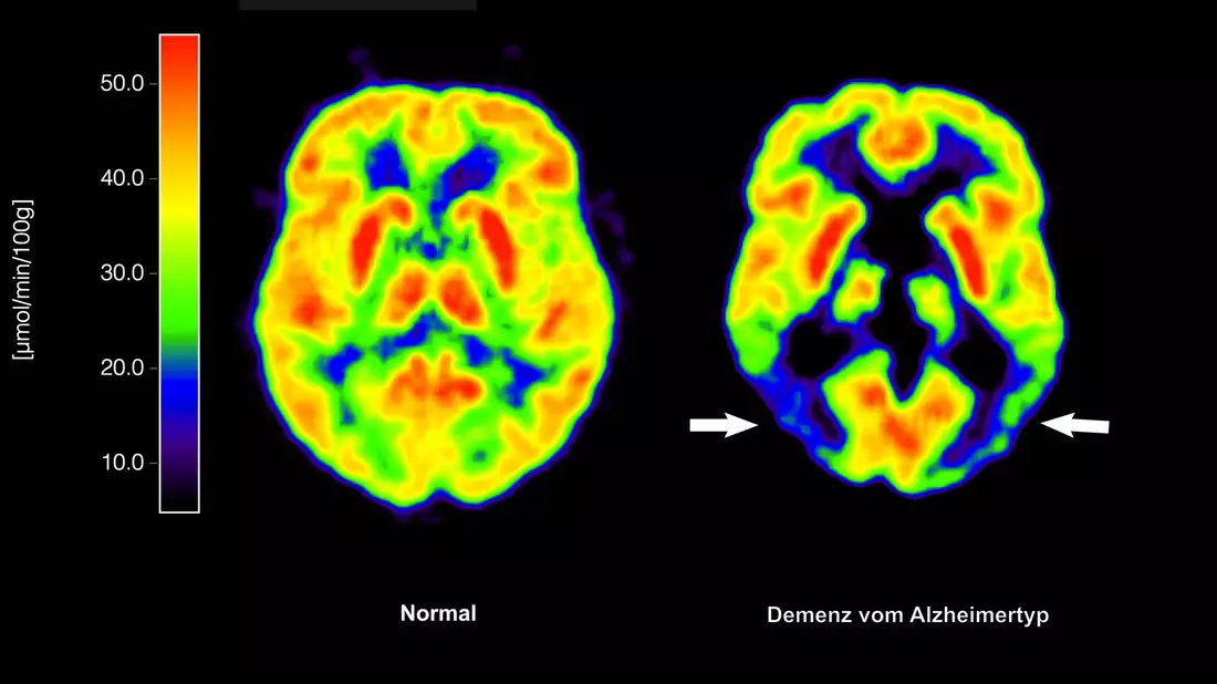 Haben die Amyloid-Plaques schon irreversible Schäden im Gehirn angerichtet, nützt ihre Entfernung nichts mehr. (Archivbild) - Bild: picture alliance / dpa