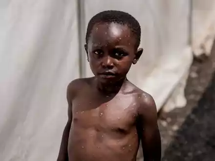 Für Kinder und immungeschwächte Menschen kann die Krankheit tödlich sein. (Archivbild) - Foto: Moses Sawasawa/AP/dpa