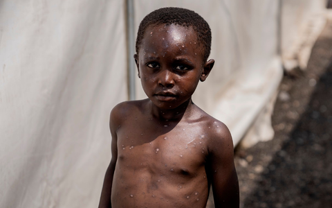 FĂŒr Kinder und immungeschwĂ€chte Menschen kann die Krankheit tödlich sein. (Archivbild) - Foto: Moses Sawasawa/AP/dpa FĂŒr Kinder und immungeschwĂ€chte Menschen kann die Krankheit tödlich sein. (Archivbild) - Foto: Moses Sawasawa/AP/dpa