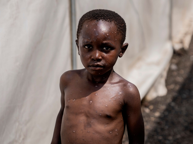 Für Kinder und immungeschwächte Menschen kann die Krankheit tödlich sein. (Archivbild) - Foto: Moses Sawasawa/AP/dpa