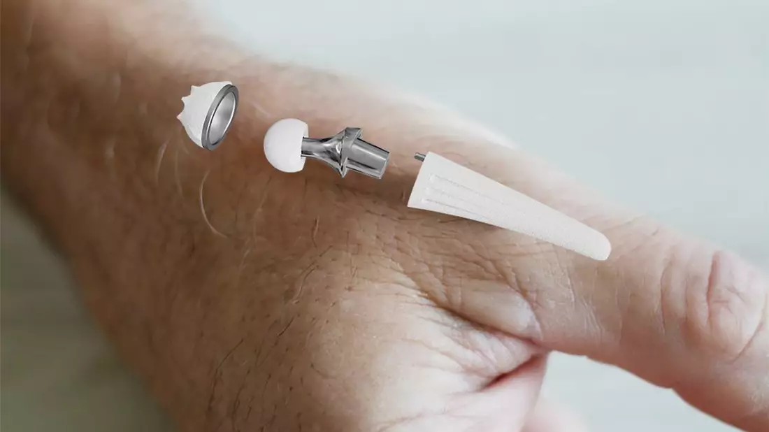 300. Implantation der Touch-Daumensattelgelenksprothese am RHÖN-KLINIKUM Campus Bad Neustadt - Bild: presseportal.de