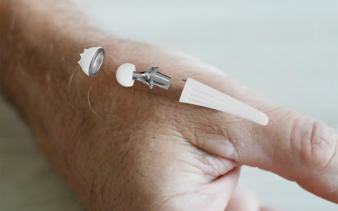 300. Implantation der Touch-Daumensattelgelenksprothese am RHÖN-KLINIKUM Campus Bad Neustadt - Foto: presseportal.de 300. Implantation der Touch-Daumensattelgelenksprothese am RHÖN-KLINIKUM Campus Bad Neustadt - Foto: presseportal.de