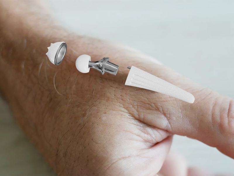 300. Implantation der Touch-Daumensattelgelenksprothese am RHÖN-KLINIKUM Campus Bad Neustadt - Foto: presseportal.de