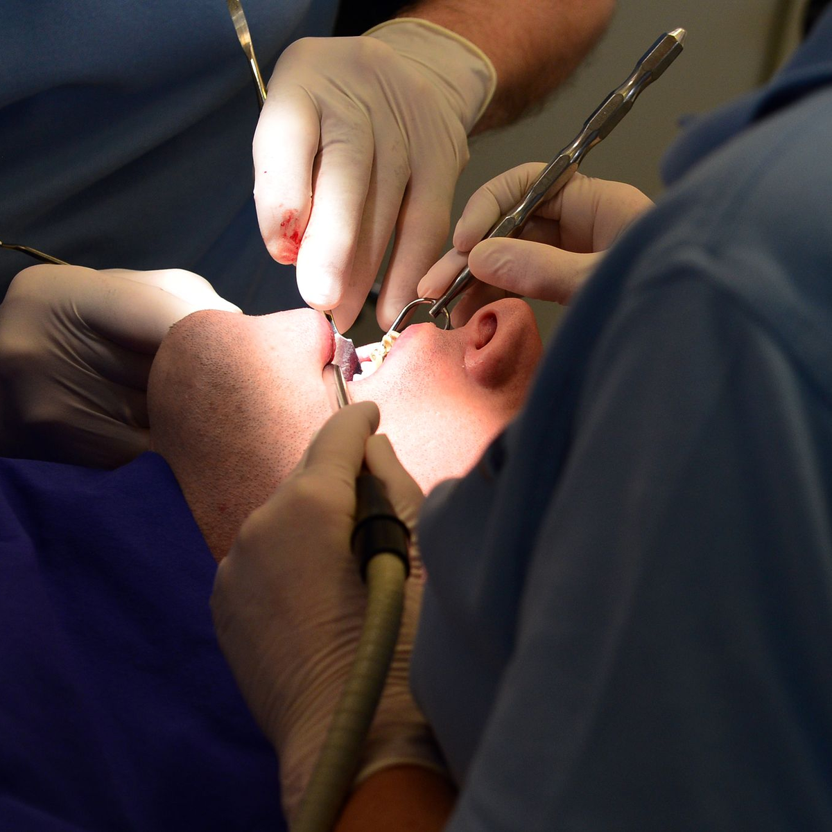 Neue Amalgam-Füllungen soll es nur noch in Ausnahmefällen geben. (Symbolbild) - Foto: Maurizio Gambarini/dpa