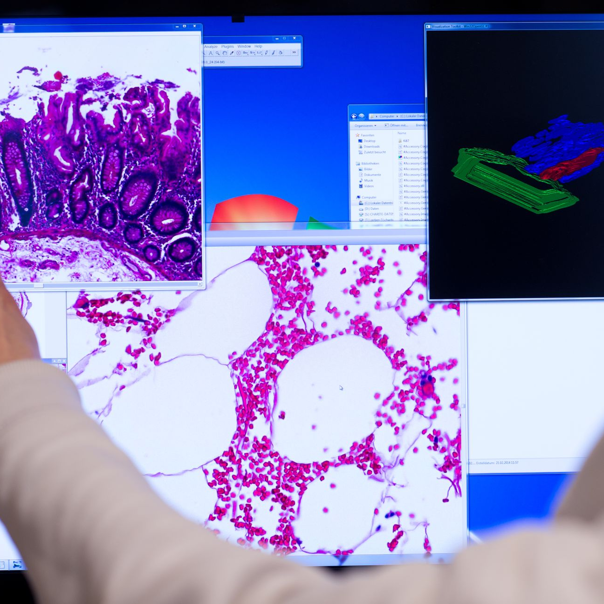 Darmkrebs ist die dritthäufigste Tumorerkrankung in Deutschland. (Archivbild) - Foto: picture alliance / Bernd von Jutrczenka/dpa