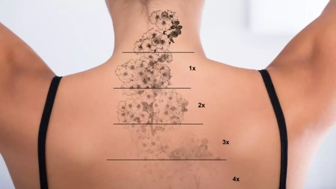 Dermatologie Quist: Tattooentfernung mit dem Picosekundenlaser – alles über Vorteile, Risiken und Vorgang - Bild: presseportal.de