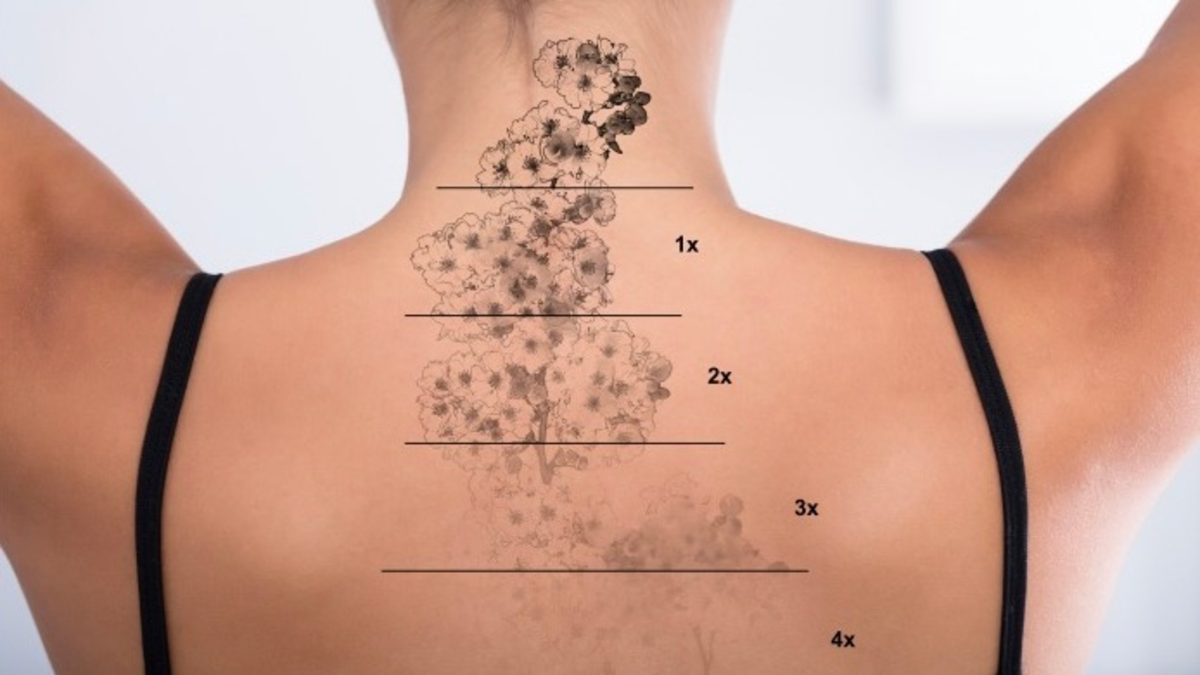 Dermatologie Quist: Tattooentfernung mit dem Picosekundenlaser – alles über Vorteile, Risiken und Vorgang - Foto: presseportal.de