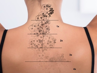 Dermatologie Quist: Tattooentfernung mit dem Picosekundenlaser – alles über Vorteile, Risiken und Vorgang - Foto: presseportal.de