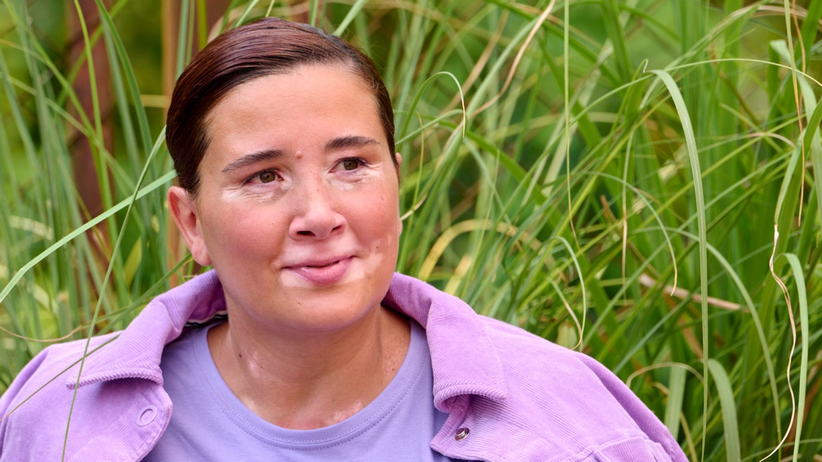 Aktuelle Behandlungsmöglichkeiten für Menschen mit Vitiligo im Jahr 2025 - Foto: presseportal.de