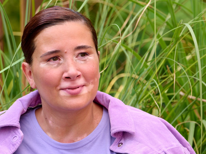Aktuelle Behandlungsmöglichkeiten für Menschen mit Vitiligo im Jahr 2025 - Foto: presseportal.de