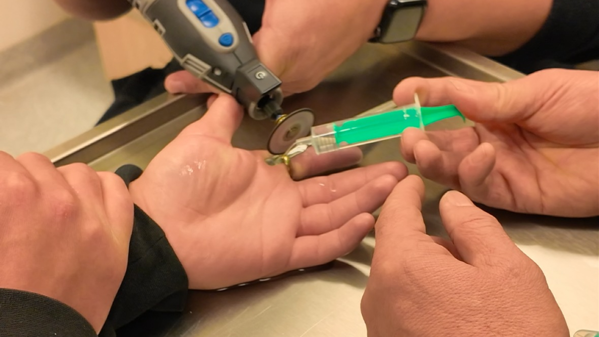 FW-OLL: Ring schnürt Finger ab - Feuerwehr entfernt Ring in der Notaufnahme - Foto: presseportal.de