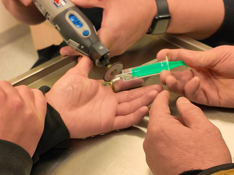 FW-OLL: Ring schnürt Finger ab - Feuerwehr entfernt Ring in der Notaufnahme - Foto: presseportal.de