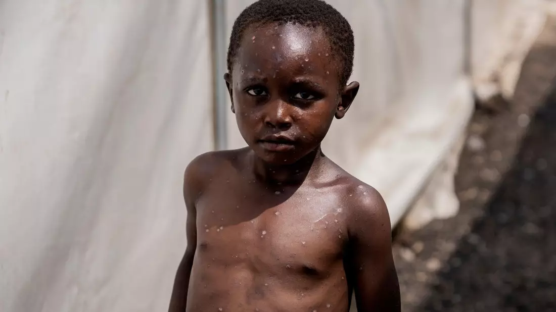 Für Kinder kann Mpox besonders gefährlich sein (Archivbild)  - Bild: Moses Sawasawa/AP/dpa