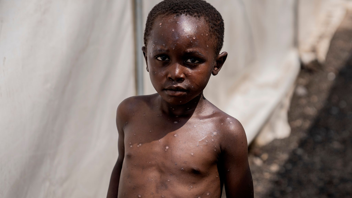 Für Kinder kann Mpox besonders gefährlich sein (Archivbild)  - Foto: Moses Sawasawa/AP/dpa