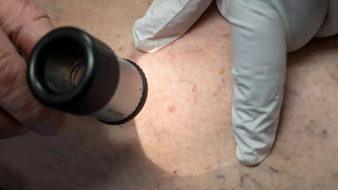 Ein Arzt untersucht in der Praxis die Hautpartie eines Patienten. (Archivbild) - Bild: Peter Kneffel/dpa
