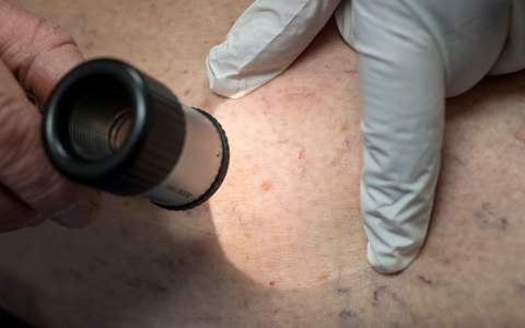 Die Zahl der Krankenhausbehandlungen von Hautkrebs stieg enorm an. (Symbolbild) - Foto: Peter Kneffel/dpa