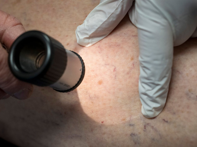 Die Zahl der Krankenhausbehandlungen von Hautkrebs stieg enorm an. (Symbolbild) - Foto: Peter Kneffel/dpa