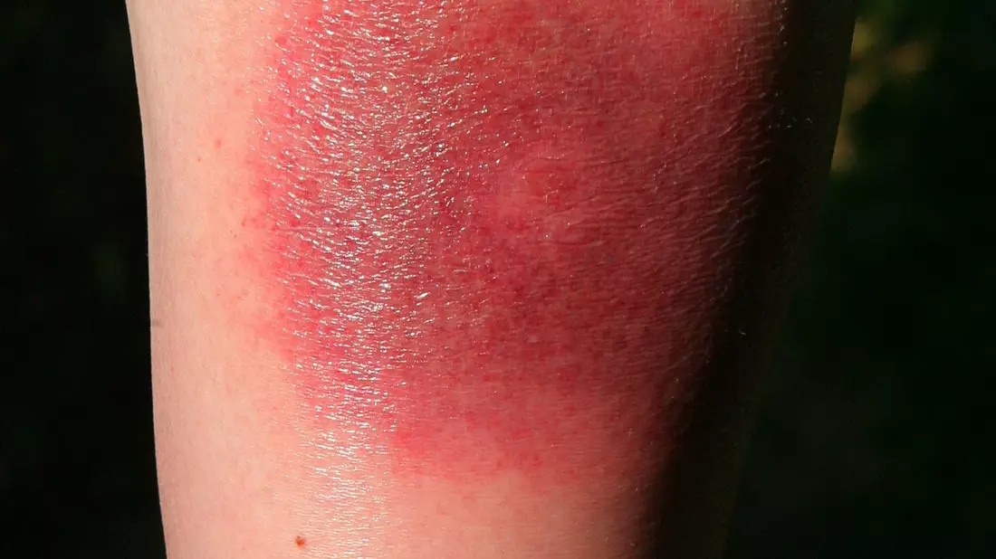 Klares Warnzeichen für Borreliose: Die sogenannte Wanderröte kann Tage oder Wochen nach einem Zeckenstich auftreten. (Archivbild) - Bild: Harry Melchert/dpa/dpa-tmn