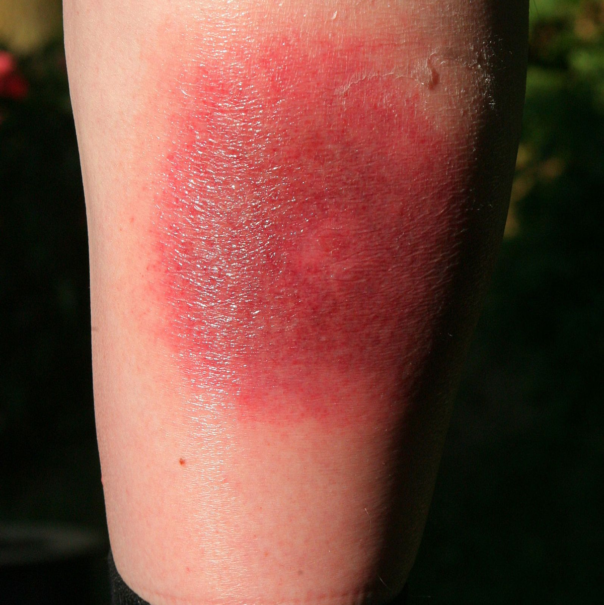 Klares Warnzeichen für Borreliose: Die sogenannte Wanderröte kann Tage oder Wochen nach einem Zeckenstich auftreten. (Archivbild) - Foto: Harry Melchert/dpa/dpa-tmn